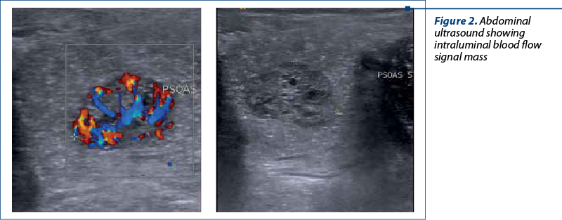 Figure 2. Abdominal ultrasound showing intraluminal blood flow signal mass