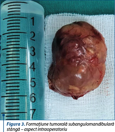 Figura 3. Formaţiune tumorală subangulomandibulară stângă – aspect intraoperatoriu