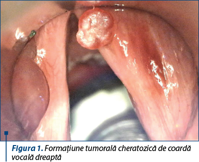 Figura 1. Formaţiune tumorală cheratozică de coardă vocală dreaptă