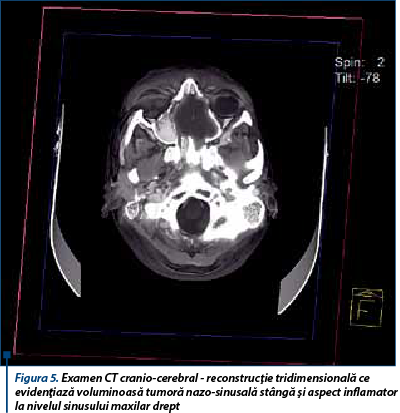 Figura 5. Examen CT cranio-cerebral - reconstrucţie tridimensională ce evidenţiază voluminoasă tumoră nazo-sinusală stângă şi aspect inflamator la nivelul sinusului maxilar drept