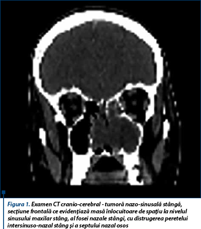 Figura 1. Examen CT cranio-cerebral - tumoră nazo-sinusală stângă, secţiune frontală ce evidenţiază masă înlocuitoare de spaţiu la nivelul sinusului maxilar stâng, al fosei nazale stângi, cu distrugerea peretelui intersinuso-nazal stâng şi a septului nazal osos