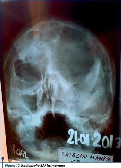 Figura 12. Radiografia SAF la internare