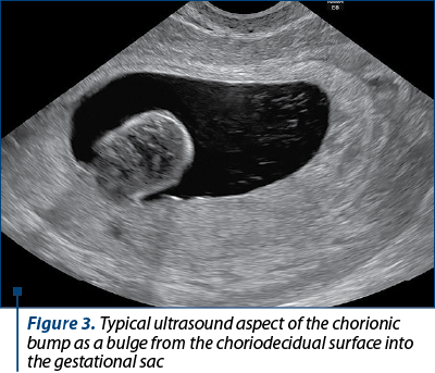 Figure 3. Typical ultrasound aspect of the chorionic bump as a bulge from the choriodecidual surface into the gestational sac