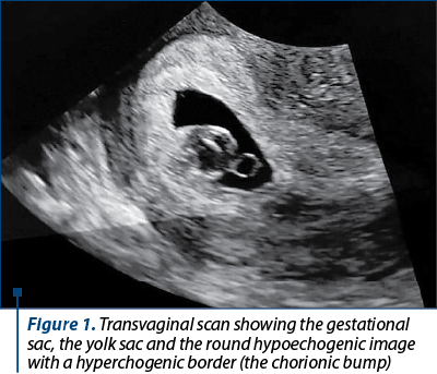Figure 1. Transvaginal scan showing the gestational sac, the yolk sac and the round hypoechogenic image with a hyperchogenic border (the chorionic bump)