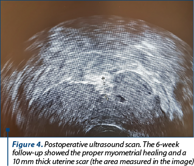 Figure 4. Postoperative ultrasound scan. The 6-week follow-up showed the proper myometrial healing and a 10 mm thick uterine scar (the area measured in the image)