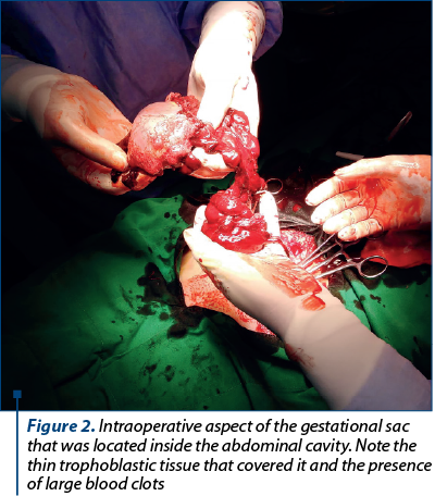 Figure 2. Intraoperative aspect of the gestational sac that was located inside the abdominal cavity. Note the thin trophoblastic tissue that covered it and the presence of large blood clots