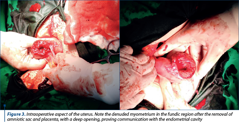 Figure 3. Intraoperative aspect of the uterus. Note the denuded myometrium in the fundic region after the removal of amniotic sac and placenta, with a deep opening, proving communication with the endometrial cavity 