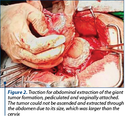 Figure 2. Traction for abdominal extraction of the giant tumor formation, pediculated and vaginally attached. The tumor could not be ascended and extracted through the abdomen due to its size, which was larger than the cervix