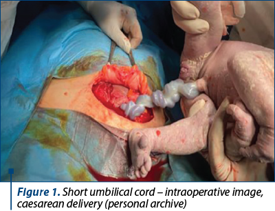 Figure 1. Short umbilical cord – intraoperative image, caesarean delivery (personal archive)