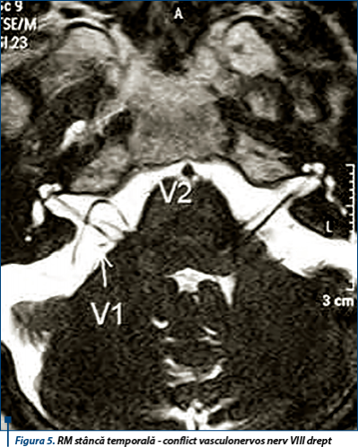 Figura 5. RM stâncă temporală - conflict vasculonervos nerv VIII drept