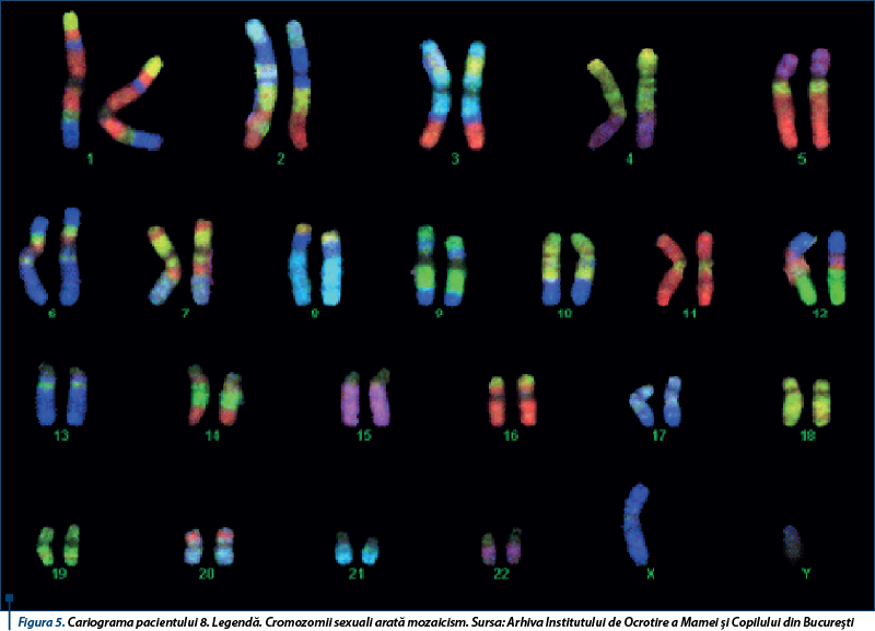 Figura 5. Cariograma pacientului 8. Legendă. Cromozomii sexuali arată mozaicism. Sursa: Arhiva Institutului de Ocrotire a Mamei şi Copilului din Bucureşti