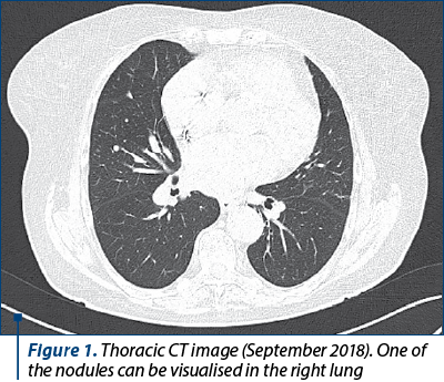 Figure 1. Thoracic CT image (September 2018). One of the nodules can be visualised in the right lung