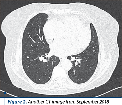 Figure 2. Another CT image from September 2018