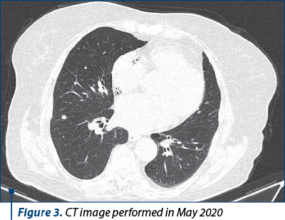 Figure 3. CT image performed in May 2020