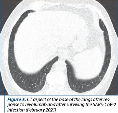 Figure 5. CT aspect of the base of the lungs after res­ponse to nivolumab and after surviving the SARS-CoV-2 infection (February 2021)