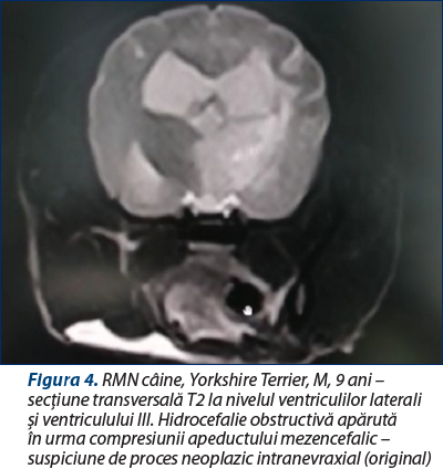 Figura 4. RMN câine, Yorkshire Terrier, M, 9 ani – secţiune transversală T2 la nivelul ventriculilor laterali şi ventriculului III. Hidrocefalie obstructivă apărută în urma compresiunii apeductului mezencefalic – suspiciune de proces neoplazic intranevraxial (original)