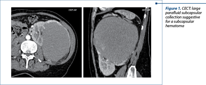 Figure 1. CECT: large parafluid subcapsular collection suggestive for a subcapsular hematoma