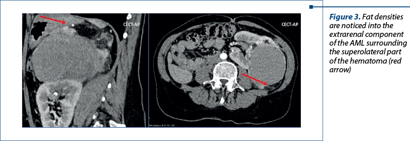 Figure 3. Fat densities are noticed into the extrarenal component of the AML surrounding the superolateral part of the hematoma (red arrow)