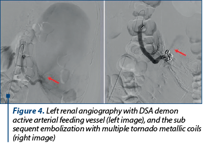 Figure 4. Left renal angiography with DSA demon­strates active arterial feeding vessel (left image), and the sub­sequent embolization with multiple tornado metallic coils (right image)