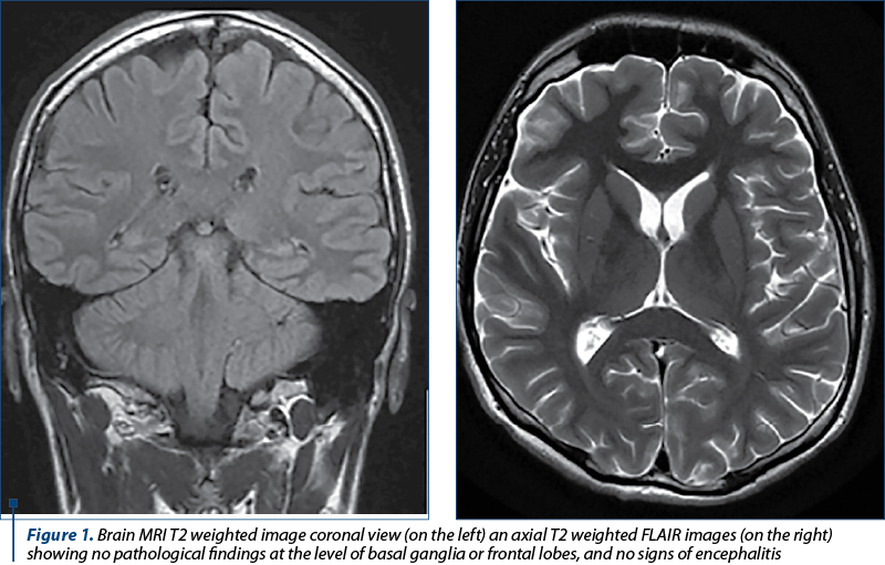Figure 1. Brain MRI T2 weighted image coronal view (on the left) an axial T2 weighted FLAIR images (on the right) showing no pathological findings at the level of basal ganglia or frontal lobes, and no signs of encephalitis