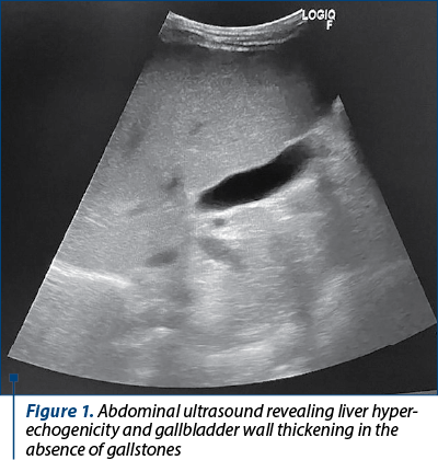 Figure 1. Abdominal ultrasound revealing liver hyper­echogenicity and gallbladder wall thickening in the absence of gallstones