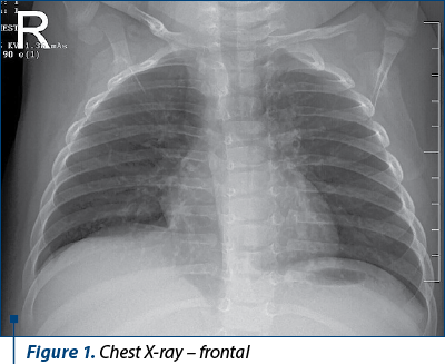 Figure 1. Chest X-ray – frontal