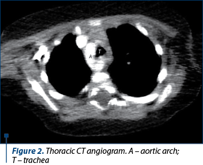 Figure 2. Thoracic CT angiogram. A – aortic arch;  T – trachea