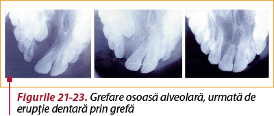 Figurile 21-23. Grefare osoasă alveolară, urmată de erupţie dentară prin grefă
