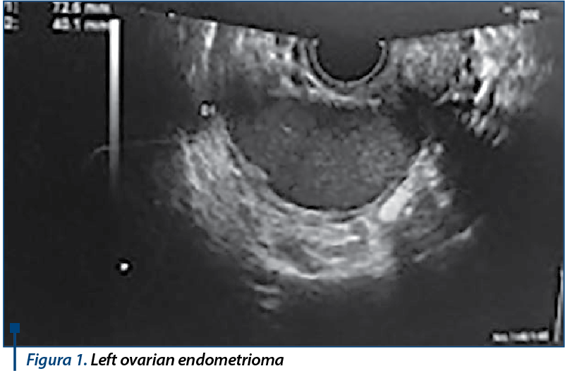 Figura 1. Left ovarian endometrioma