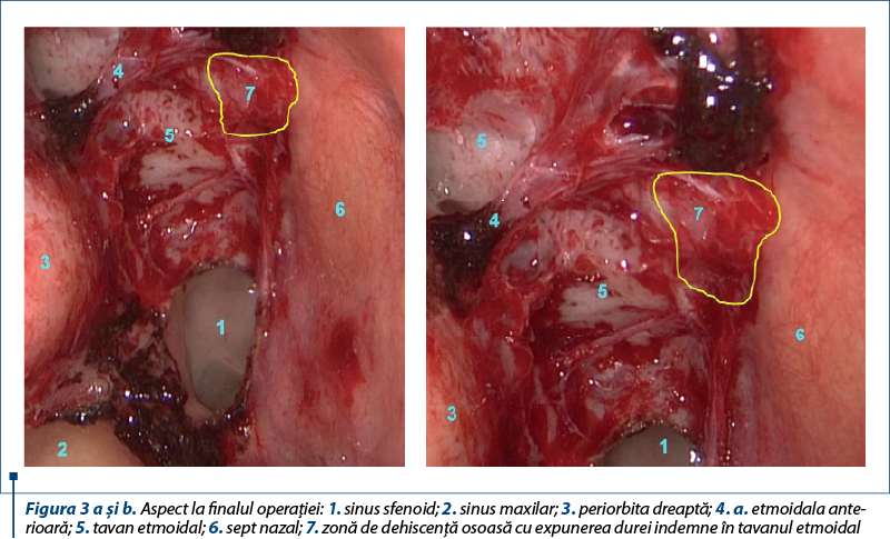 Figura 3 a şi b. Aspect la finalul operaţiei: 1. sinus sfenoid; 2. sinus maxilar; 3. periorbita dreaptă; 4. a. etmoidala ante­rioa­ră; 5. tavan etmoidal; 6. sept nazal; 7. zonă de dehiscenţă osoasă cu expunerea durei indemne în tavanul etmoidal