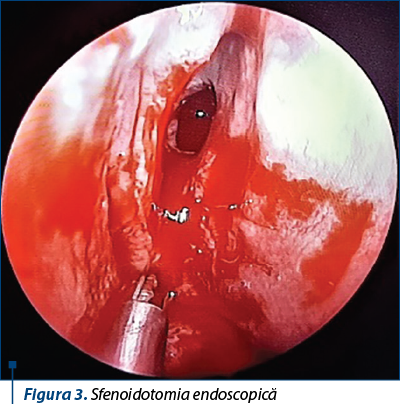 Figura 3. Sfenoidotomia endoscopică
