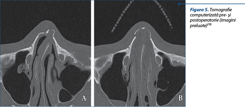 Figura 5. Tomografie computerizată pre- şi postoperatorie (imagini preluate)(10)