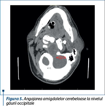 Figura 5. Angajarea amigdalelor cerebeloase la nivelul găurii occipitale
