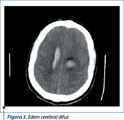 Figura 3. Edem cerebral difuz