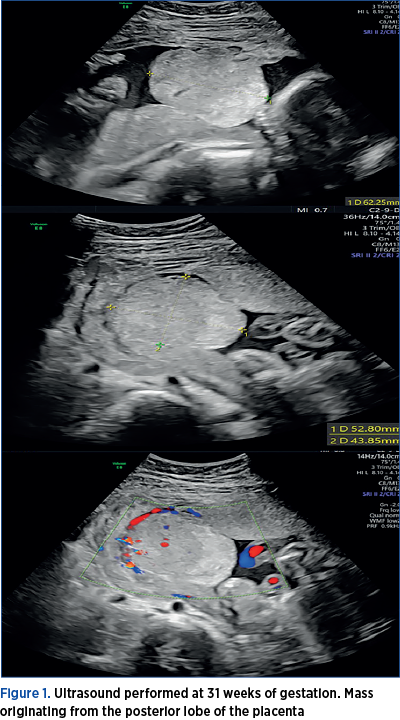 Figure 1. Ultrasound performed at 31 weeks of gestation. Mass originating from the posterior lobe of the placenta