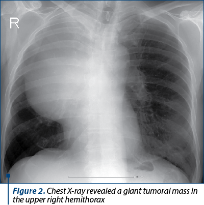 Figure 2. Chest X-ray revealed a giant tumoral mass in the upper right hemithorax