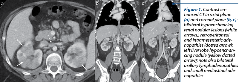Figure 1. Contrast en­hanced CT in axial plane (a) and coronal plane (b, c): bi­la­te­ral hy­po­en­chan­cing re­nal no­du­lar lesions (white ar­rows), retroperitoneal and in­tra­me­sen­teric ade­no­pa­thies (dotted arrow); left li­ver lobe hy­po­en­chan­cing no­dule (yellow dotted arrow); note also bilateral axillary lymphadenopathies and small mediastinal ade­no­pa­thies