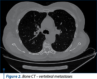 Figure 2. Bone CT – vertebral metastases