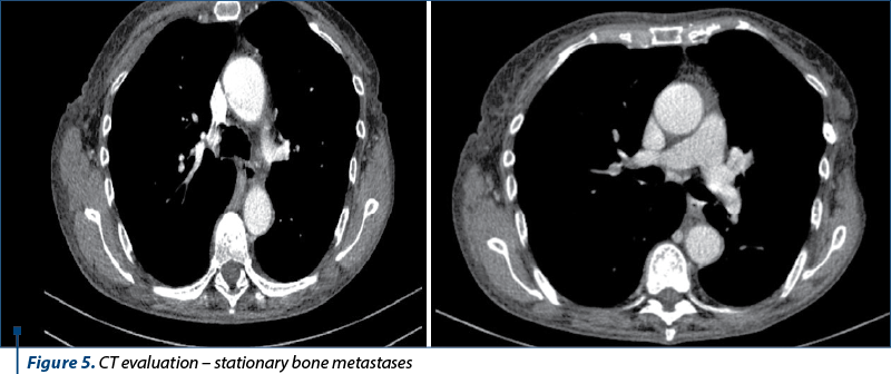 Figure 5. CT evaluation – stationary bone metastases