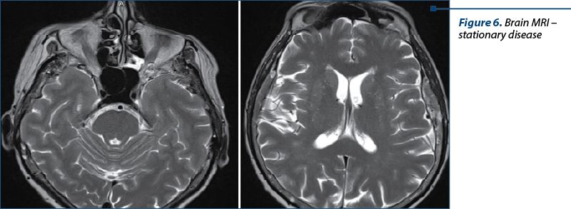 Figure 6. Brain MRI – stationary disease