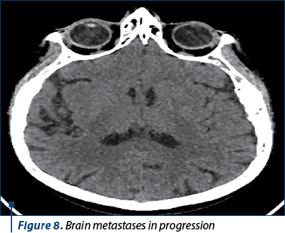 Figure 8. Brain metastases in progression