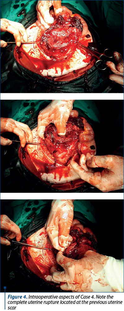 Figure 4. Intraoperative aspects of Case 4. Note the complete uterine rupture located at the previous uterine scar
