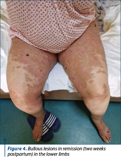 Figure 4. Bullous lesions in remission (two weeks postpartum) in the lower limbs