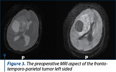 Figure 3. The preoperative MRI aspect of the fronto-temporo-parietal tumor left sided 