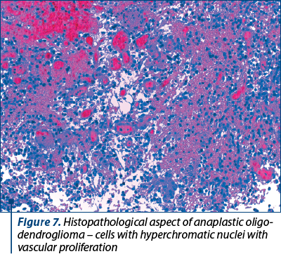 Figure 7. Histopathological aspect of anaplastic oligo­den­droglioma – cells with hyperchromatic nuclei with vascular proliferation