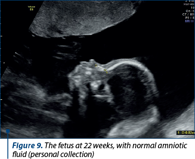Figure 9. The fetus at 22 weeks, with normal amniotic fluid (personal collection)