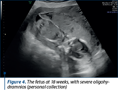 Figure 4. The fetus at 18 weeks, with severe oligo­hy­dram­nios (personal collection)