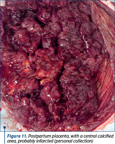 Figure 11. Postpartum placenta, with a central calcified area, probably infarcted (personal collection)