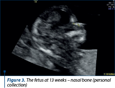 Figure 3. The fetus at 13 weeks – nasal bone (personal collection)