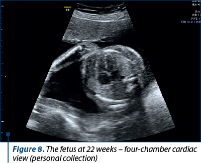 Figure 8. The fetus at 22 weeks – four-chamber cardiac view (personal collection)